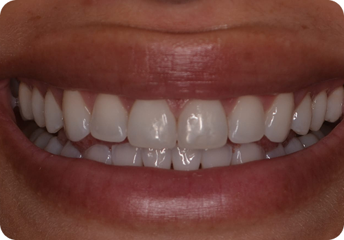 After treatment
