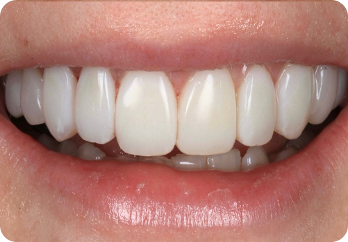After treatment