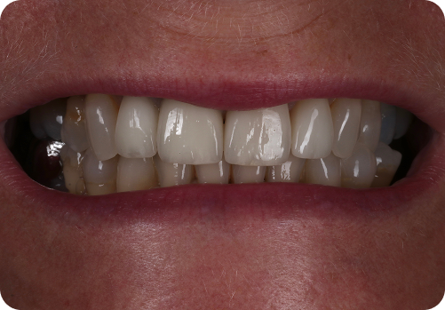 After treatment