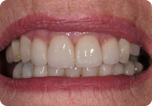 After treatment