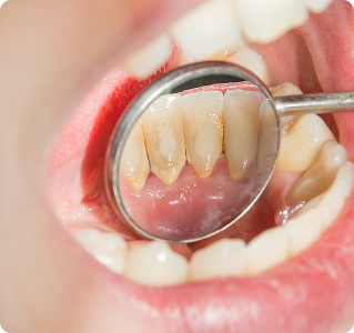 Stained Teeth