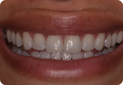 After treatment
