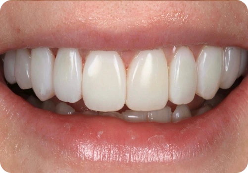 After treatment