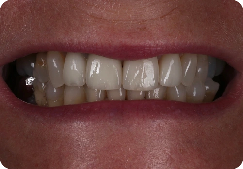 After treatment