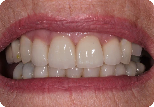 After treatment