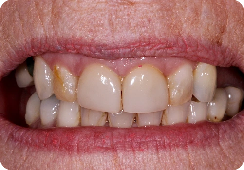 Before treatment