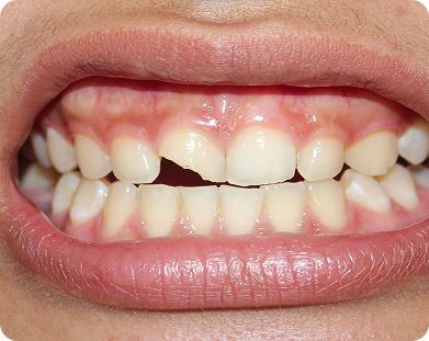 Chipped Teeth