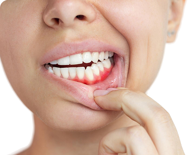 Bleeding Gums