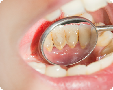 Stained Teeth