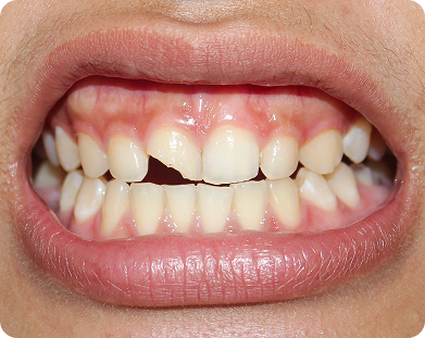 Chipped Teeth